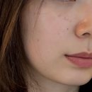 리더스덴탈 | 송도 성형외과 리투오| 요즘 핫한 스킨부스터 솔직후기