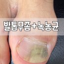 베리굿케어울산내성발톱무좀