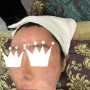 고운 피부과의원 | 내돈내산 방배 고운피부과의원 주사피부염 히라셀 시술 후기