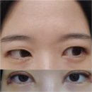 쌍수 절개 재수술 내돈내산 후기(당일~일주일차, 지방제거,피부절제)