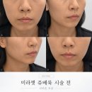 청담피부과 | 청담피부과 쥬베룩 내돈내산 후기 | 손주사 vs 미라젯 시술 통증 효과 비교