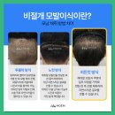 헤어라인교정후기에서 아무도 안 보여주는 것