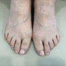 서래가정의학과의원 | 반포동 내성발톱 무좀치료 수술 대신 케어