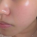 양평보셀르의원 기미주근깨피코토닝 레이저후기
