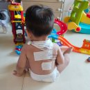 동천맑은약국 | 14개월아기 수포성 인후염 증상 시작은 콧물이었어요..