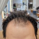 우성농협 | 동탄두피관리 잘하는 곳, 화성목동미용실 서헤어에서 모발생장술 1회 받아본 후기