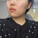 리필톡의원 | 강남 오앤의원 AI 얼굴 분석 진단 + 올타이트 리프팅 내돈내산 후기