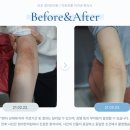아토피 면역억제제 부작용 5가지와 대처 방법 - 사이폴엔 오래 먹어도 괜찮을까요?