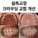 서울화이트에스(S)치과의원 | 설측교정 크라우딩 비발치 교정, 발음 걱정 없이 진행한 콤비교정으로 교합까지 개선 후기
