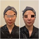 부산시설공단 서면지하도상가 서면몰 | 부산 서면 카리언 뷰티 클리닉 | 서면작은얼굴 서면 '브이로(V-ro) 윤곽관리' 후기
