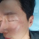 수원 튼살커버 잘하는곳 스킨52