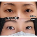 아이브성형외과의원 | 자연유착쌍꺼풀수술후기 눈붓기빨리빼는법 알고 싶다면!