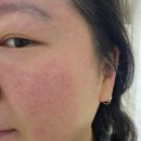 소생한의원 | 부산 서면 피부장벽관리 LDM 물방울리프팅 내돈내산 후기