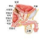 고환암의 발생부위 이미지