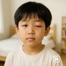 시온위생물수건 | 속다래끼 초기증상, 원인, 전염 및 눈다래끼 약 치료