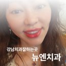 웃는얼굴치과의원 | 강남치과잘하는곳 뉴엔치과 퍼스널라미 찐 후기!