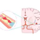 급성 뇌경색 원인 초기 전조 증상 골든타임 치료 후유증 재활 뇌경색에 좋은 음식 함께 알아볼까 이미지
