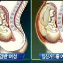 일반여성 vs 임신 거부증 여성의 만삭 (feat : 임테기를 하면 1줄일까 2줄일까?) 이미지