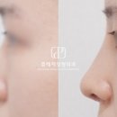 흔이나게 | 남자코성형 후기, 성공적인 결과를 위해 필요한 것