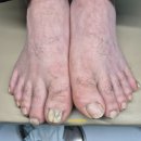 종일자동차공업사 | [발톱무좀]자동차공업사 30대 남성, 발톱이 멍들고 아파지기까지… “이제는 더 미룰 수 없었습니다...