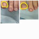 푸스케어 수원호매실점 | 내돈내산 내성발톱 푸스케어 호매실점 후기(혐오사진주의)