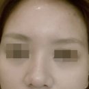 만택루쎄의원 | [강변 만택루쎄의원] 이마필러 후기