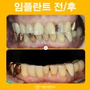 치근단 병소 = 치아 뿌리 염증 : 장안구 치과 네이게이션 임플란트 식립
