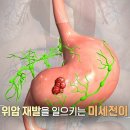 [998회] 생로병사의 비밀/[2026 위암 보고서,재발과 전이]위암의 전이와 재발을 막는 새로운 치료 전략, 수술 전 우리 몸의... 이미지