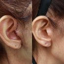 지뢰밭골(3) | 안면거상술후기 사진, 이 3가지는 반드시 확인하세요. <대표원장 작성>