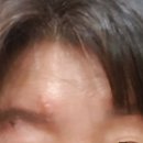 신진의료기 | 50대 면역력이 떨어지면 &#34;대상포진&#34; 걸릴까? 면역 대상포진 걸린 후기