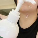 장미색비강진후기, 3개월 동안 퍼지는 붉은 반점