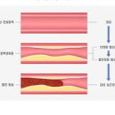 협심증 전조 및 원인 검사 : 가슴 가운데 통증 이미지