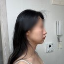 윤곽성형외과의원 | 강남역성형외과 윤곽주사 후기 이중턱 없어지는 지방분해주사 원더핏주사