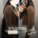 변화의 시작 몸 펴기 생활운동(기초) | 팔뚝지방흡입 후기 일주일 차 변화와 후관리 압박복 팁