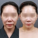 거상광고 | 안면거상 후기, 6개월 사진보다 먼저 봐야 할 회복 과정