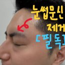 닥터윤뷰티플의원 | 천안눈썹문신제거, 후기보다 중요한 현실적인 조언?