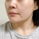 타임락 | 삼성동피부과 튠페이스 가격 타임락튠 후기
