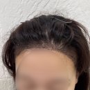 서진성형외과의원 | [[서진성형외과] 압구정에서 라인컷 비절개 모발이식 받고 온 2주차 후기