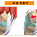 무릎에서 ‘뚝뚝’ 소리가 난다? 이미지