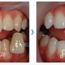 Re:강남 연세샘치과 치아미백 문의[강남연세샘치과 답변입니다*^^*] 이미지