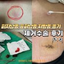 옵티마든든약국 | 등종기 피지낭종 지방종 표피낭종 제거수술 비용 항생제연고 포비돈 소독 피부과 외과 치료 처방 후기~