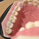 링구얼라인 이미지