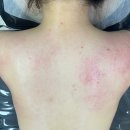 1cm | 강남 네일샵 드림네일 복부 관리 | 한 번 받고 허리둘레 1cm 줄어든 후기