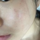 해운대에스테틱 해운대피부관리 더쎄라펜 은빛볼륨테라피 주름 모공 관리 후기