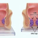 내 엉덩이에 포도송이가? 치질 중에서 가장 흔한 치핵 수술 대작전!