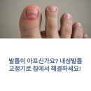 내성발톱 교정기 추천 TOP 5