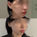 코아메디칼 | 웨딩촬영 직전 얼굴라인 관리 부산윤곽관리 코아페이즈 후기