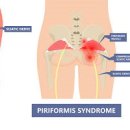 엉덩이 통증 원인 6가지 이미지