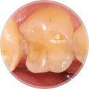 연세이튼튼치과의원 | 유성구 원신흥동 연세맘편한치과 하이브리드 인레이 치료과정,후기 총정리!