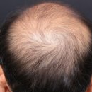 삼산초등학교 | 부평탈모병원, 마지막으로 시도한 리제네라액티바 3개월차 탈모치료 후기